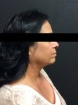 Ultherapy Case 4 After